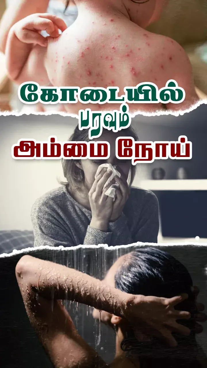 அம்மை நோய் அச்சம் வேண்டாம்