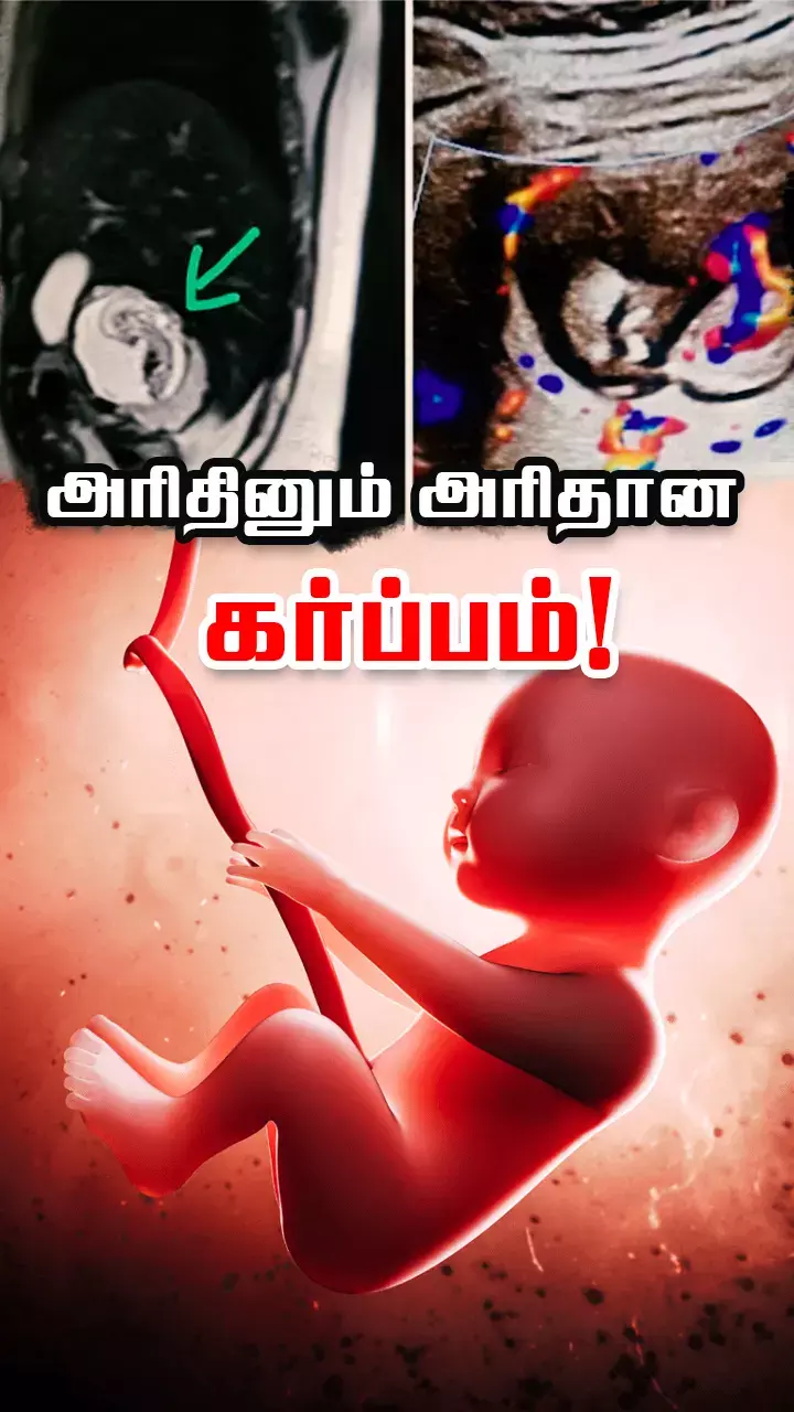 கர்ப்பப்பைக்கு பதிலாக கல்லீரலுக்குள் வளர்ந்த குழந்தை!